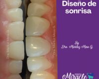 Microdiseño de sonrisa